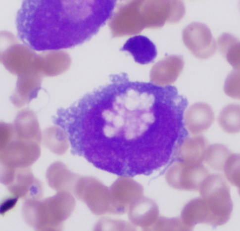 Fig. 5 Bone marrow aspirate. Blasts with delicate chromatin and prominent nucleoli (Fig. 5a). Many of the blasts/blast equivalents exhibited large folded or bizarre nuclei (Fig. 5b). There is abundant basophilic cytoplasm with cytoplasmic blebbing and extensive vacuolization (Fig. 5c). Prominent eosinophilic peri-nuclear hofs are present, which range in appearance from collections of eosinophilic granules (Fig. 5d) to collections of small vacuoles (Fig. 5e). Hemophagocytosis is also seen (Fig. 5f).